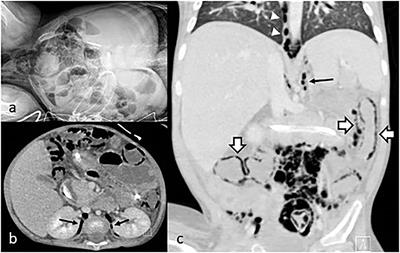 Case Report: Massive Intestinal Pneumatosis and Pneumoretroperitoneum Following Hematopoietic Stem Cell Transplantation in a 2-Year-Old Child